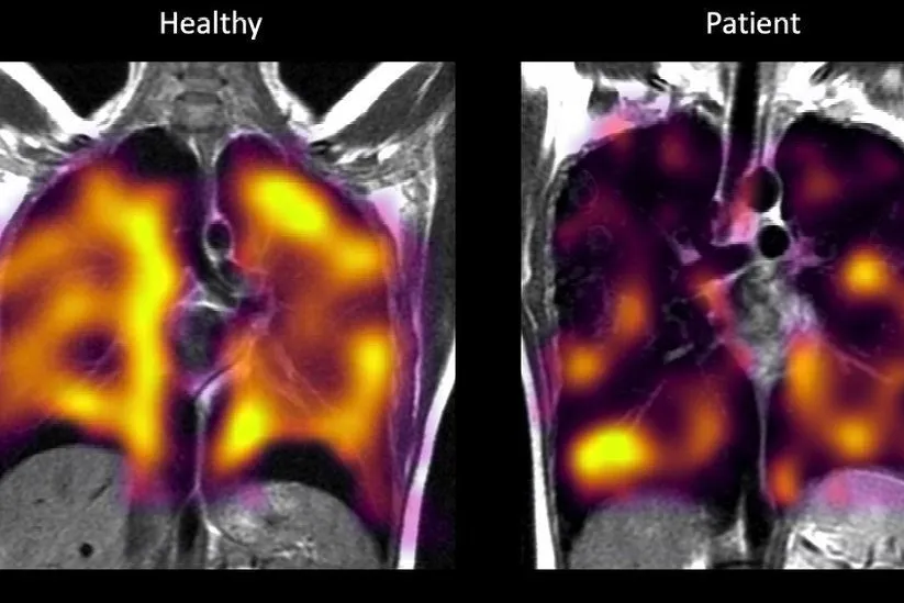 Lungs In Long Covid Patients Suffering Damage